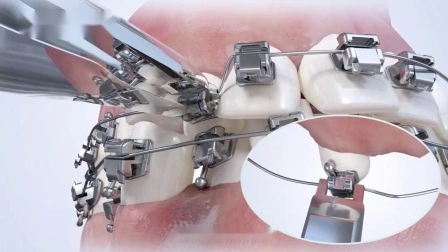 Fabricación de productos de ortodoncia Producto de soportes de dientes de autoligado pasivo de ortodoncia